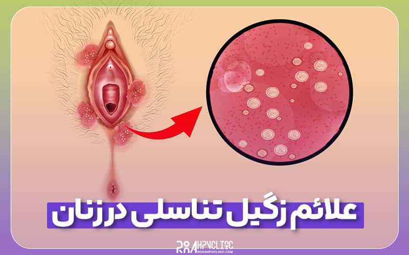 علائم زگیل تناسلی در زنان