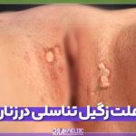 علت زگیل تناسلی در زنان
