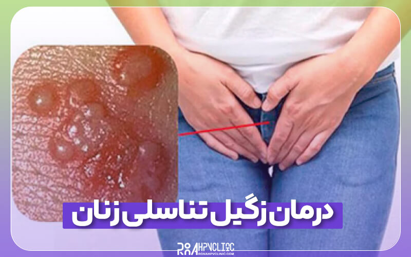 درمان زگیل تناسلی زنان