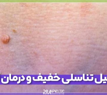 زگیل تناسلی خفیف و درمان آن