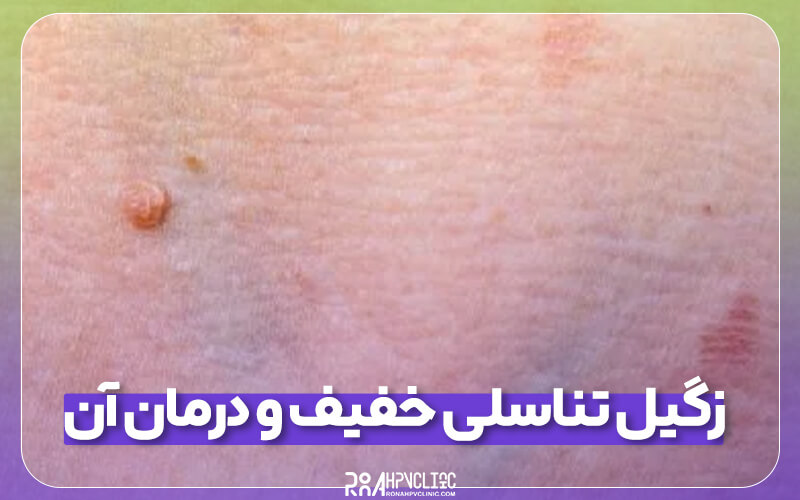 زگیل تناسلی خفیف و درمان آن