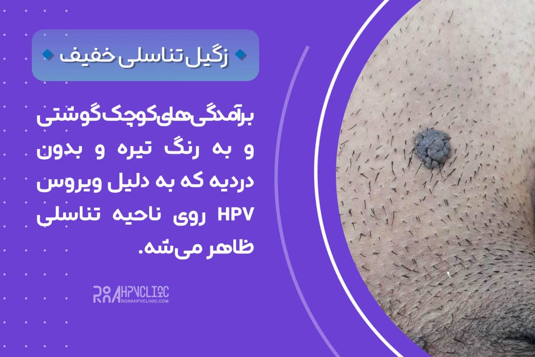  زگیل تناسلی خفیف