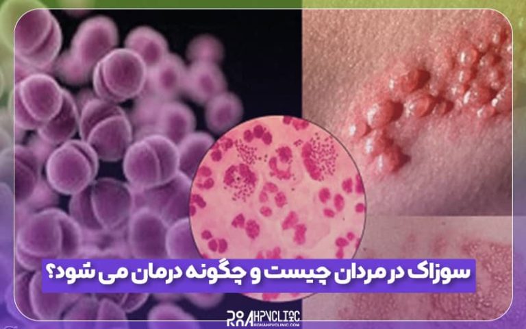 سوزاک در مردان چیست و چگونه درمان می شود؟