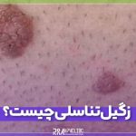 زگیل تناسلی چیست؟