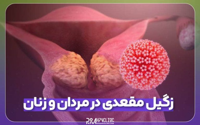 زگیل مقعدی در مردان