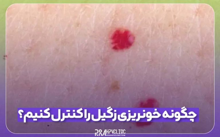 چگونه خونریزی زگیل را کنترل کنیم؟ 1