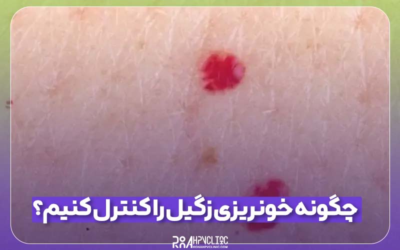 خونریزی زگیل را کنترل کنیم؟ 1