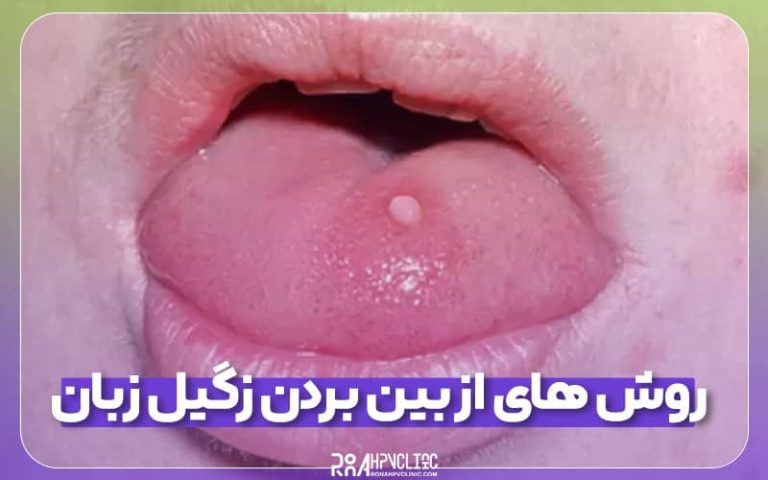 روش های از بین بردن زگیل زبان