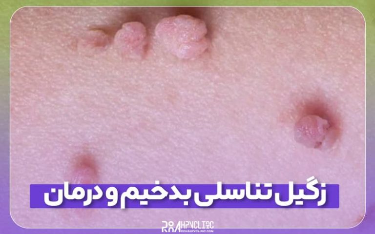 زگیل تناسلی بدخیم و درمان