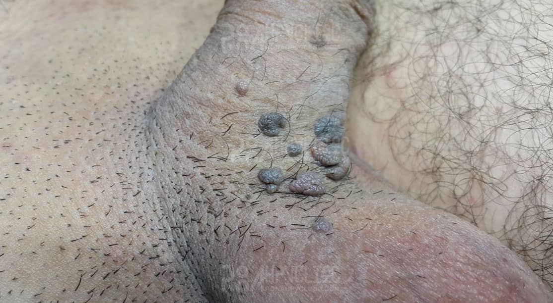 عکس خفن عکس زگیل تناسلی نوع ۱۸