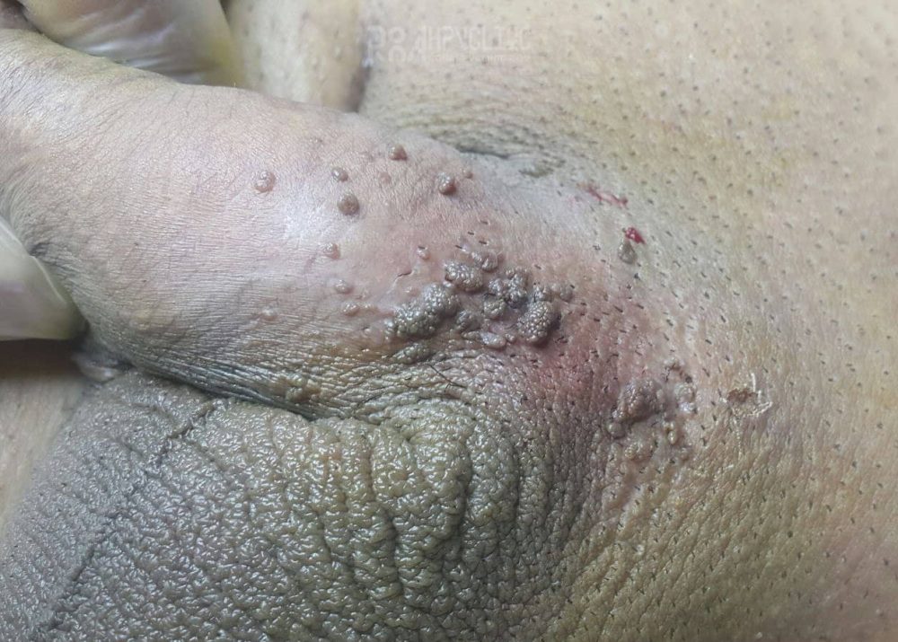 عکس خفن عکس زگیل تناسلی نوع ۱۸