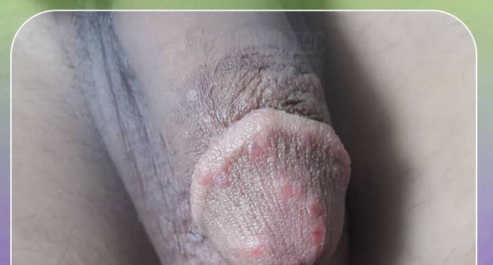 عکس خفن عکس زگیل تناسلی نوع ۱۸