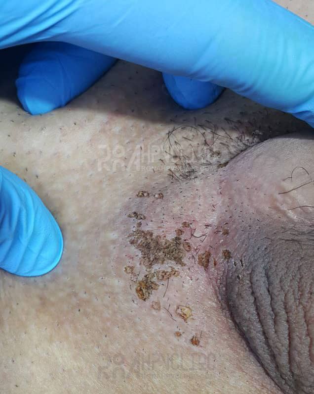 عکس زگیل تناسلی کم خطر در مردان