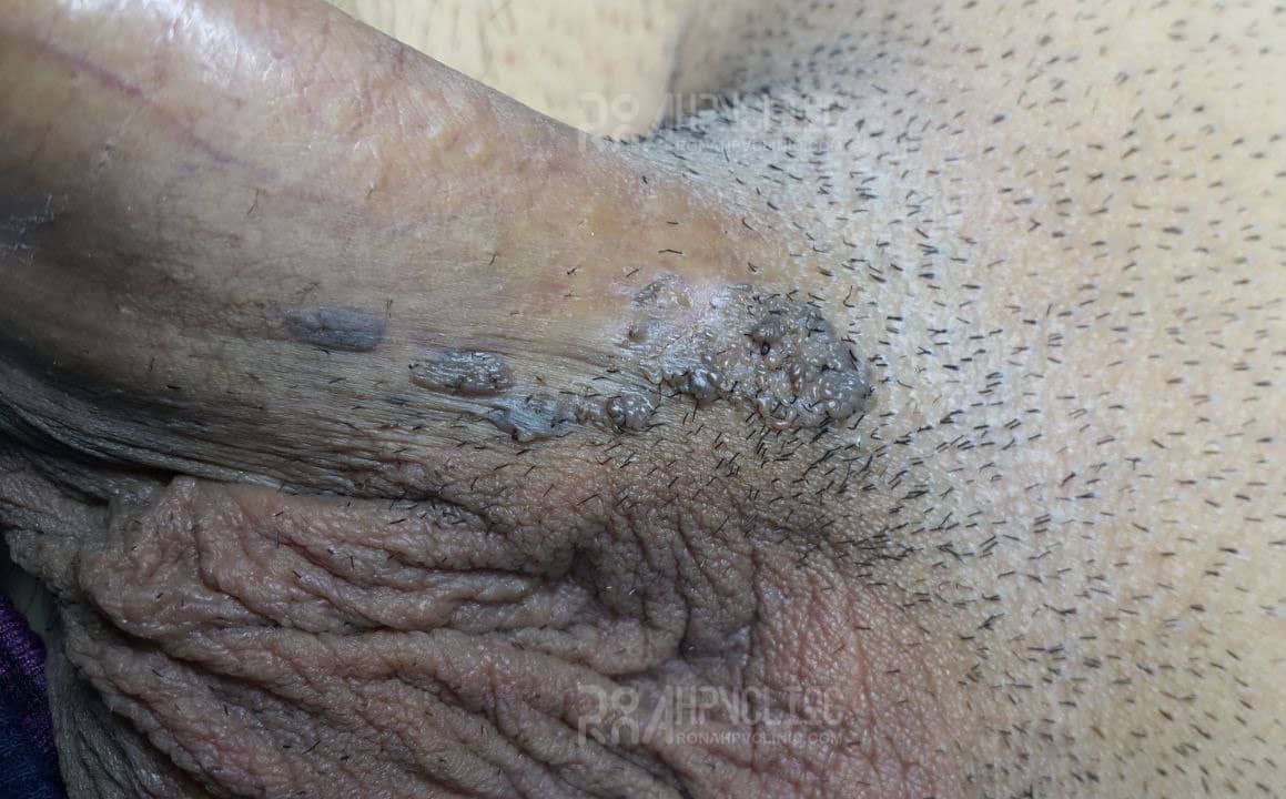 عکس واضح از زگیل تناسلی زنان نی نی سایت