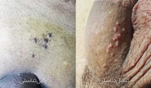 تبخال تناسلی و زگیل