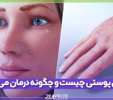 زگیل پوستی چیست و چگونه درمان می‌شود