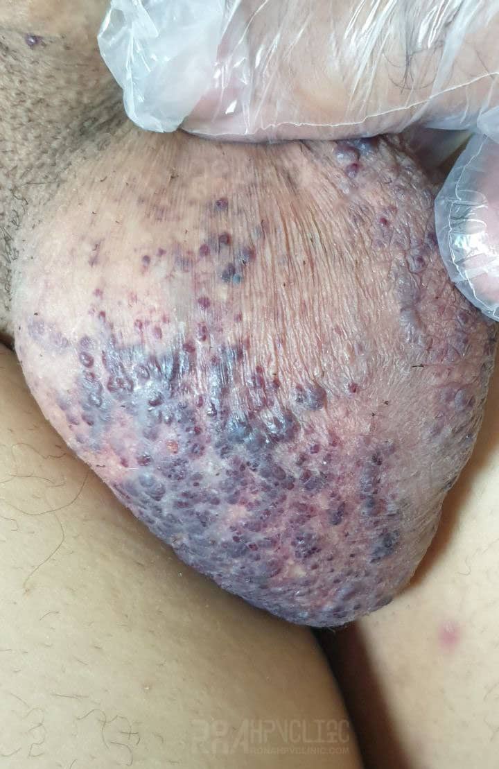 عکس خفن عکس زگیل تناسلی نوع ۱۸