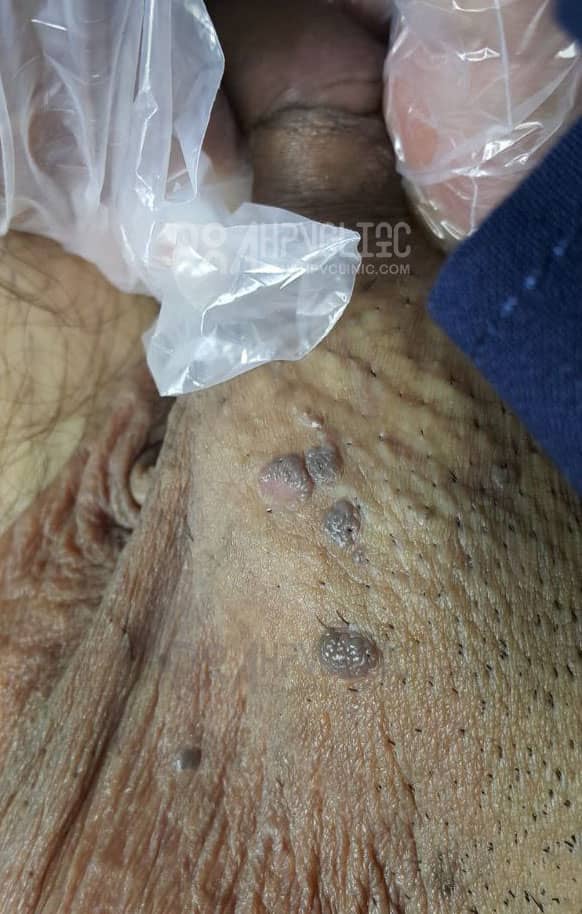 عکس خفن عکس زگیل تناسلی نوع ۱۸