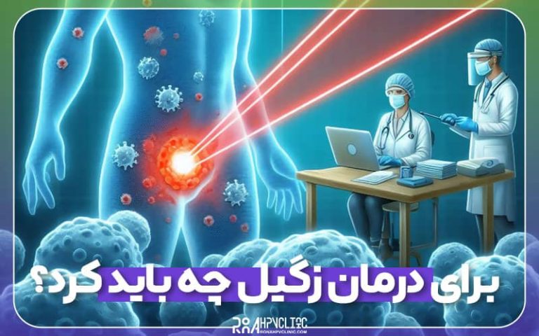 روش_های درمان زگیل