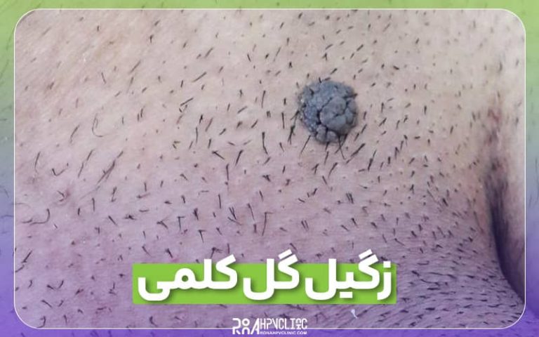 زگیل گل کلمی