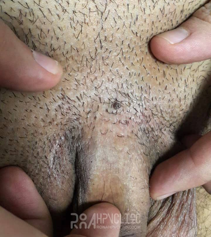 عکس خفن عکس زگیل تناسلی نوع ۱۸