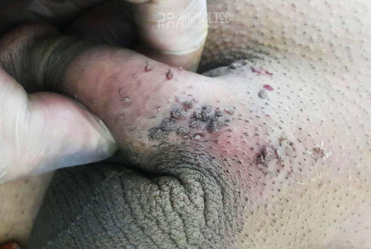 عکس خفن عکس زگیل تناسلی نوع ۱۸