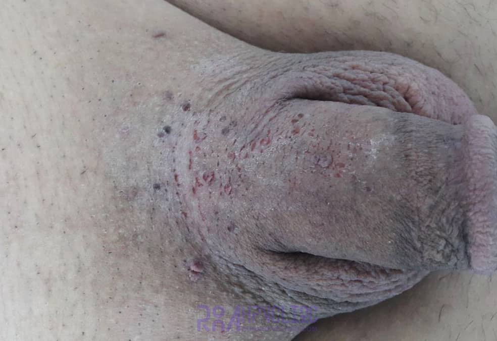 عکس خفن عکس زگیل تناسلی نوع ۱۸