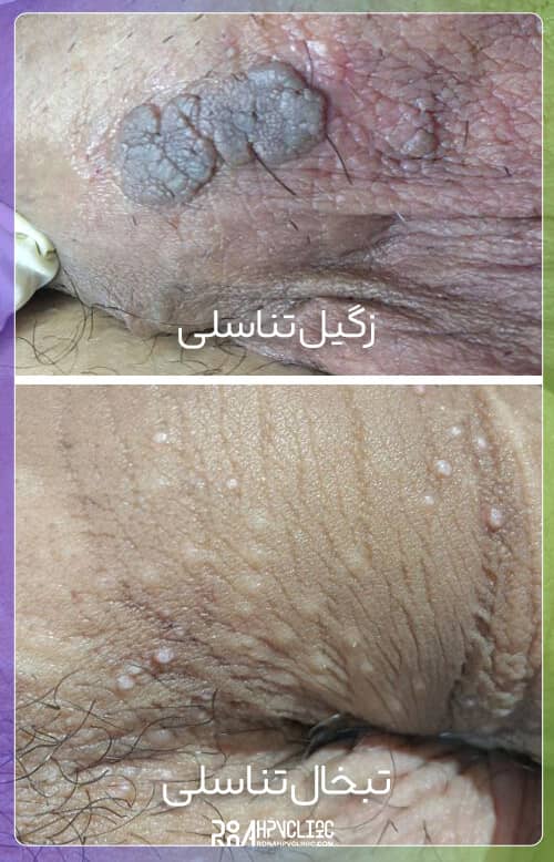 عکس تبخال و زگیل تناسلی