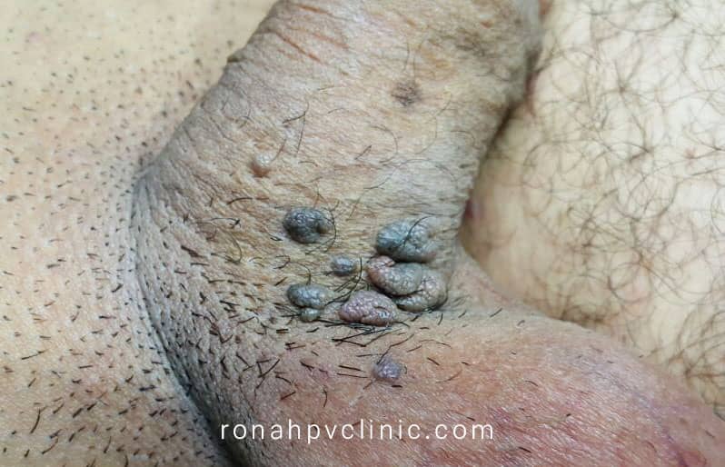 عکس خفن عکس زگیل تناسلی نوع ۱۸