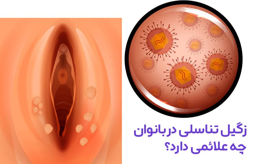 زگیل تناسلی در بانوان