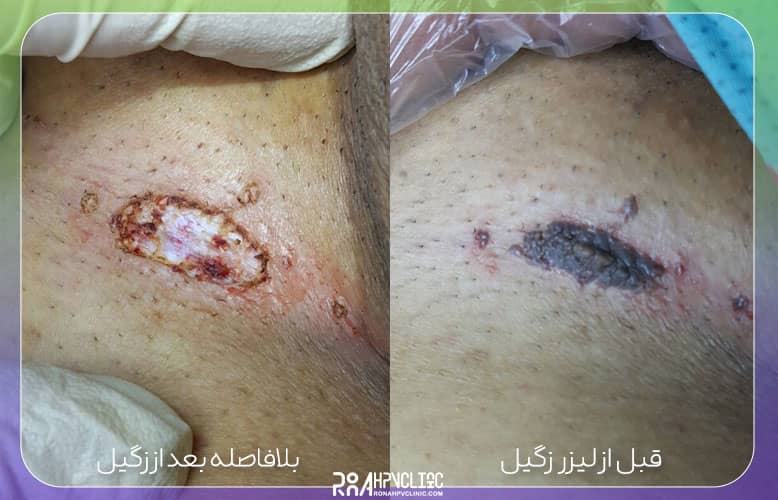 عکس خفن عکس زگیل تناسلی نوع ۱۸