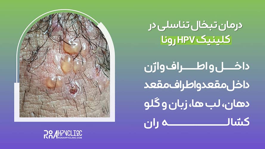 درمان و رفع تبخال تناسلی در سه دقیقه