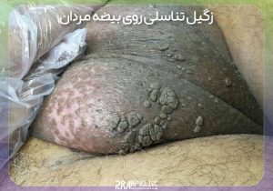 زگیل روی بیضه و آلت روش درمان و عکس زگیل روی بیضه مردان 2 زگیل روی بیضه