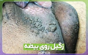 زگیل روی بیضه و آلت روش درمان و عکس زگیل روی بیضه مردان 5 زگیل روی بیضه مردان