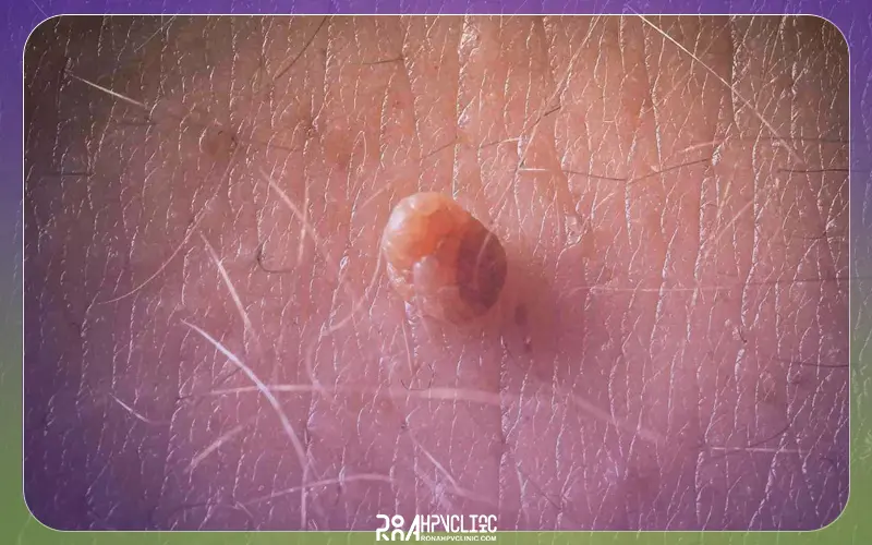 زگیل واژن چیست و چه علائمی دارد؟