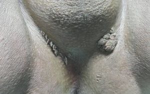 زگیل روی بیضه و آلت روش درمان و عکس زگیل روی بیضه مردان 3 عکس زگیل روی بیضه