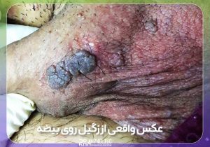 زگیل روی بیضه و آلت روش درمان و عکس زگیل روی بیضه مردان 4 عکس واقعی از زگیل روی بیضه