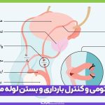 وازکتومی