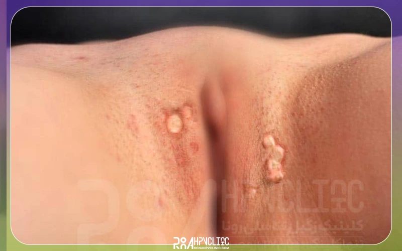 زگیل تناسلی در دختر مجرد چگونه است؟ دختران مجرد بخوانند (محرمانه) 17 علائم زگیل تناسلی در دختر مجرد