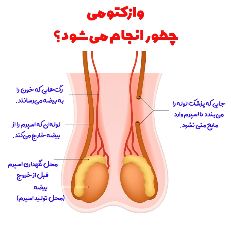 نحوه عمل جراحی وازکتومی