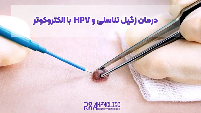 درمان HPV با الکتروکوتر