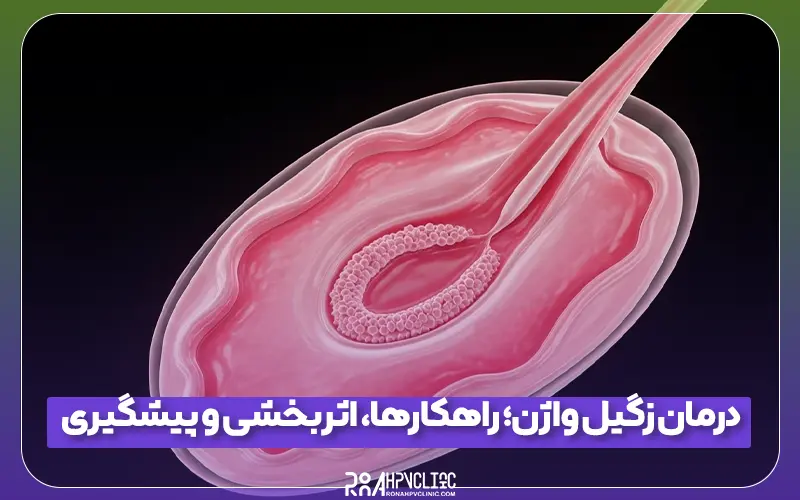 درمان زگیل واژن راهکارها، اثربخشی و پیشگیری 1 درمان زگیل واژن؛ راهکارها، اثربخشی و پیشگیری