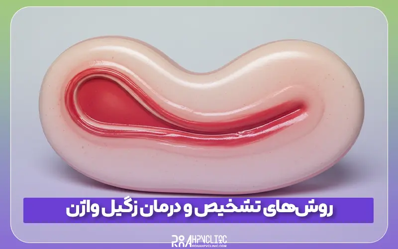 درمان زگیل واژن راهکارها، اثربخشی و پیشگیری 5 روشهای تشخیص و درمان زگیل واژن
