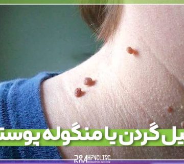 زگیل گردن چیست