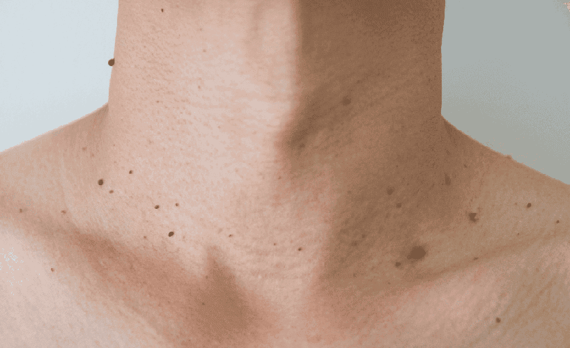 زگیل گردن چیست