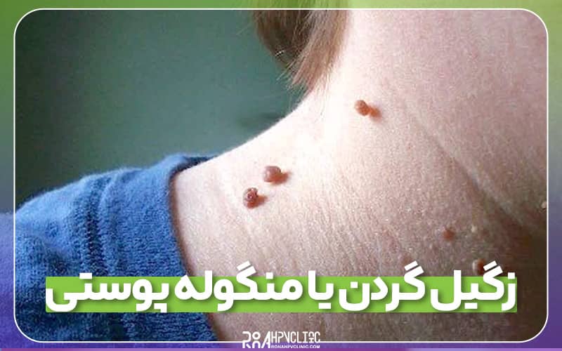 کلینیک hpv رونا 77 زگیل گردن چیست