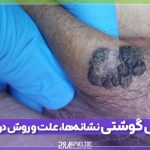 زگیل گوشتی