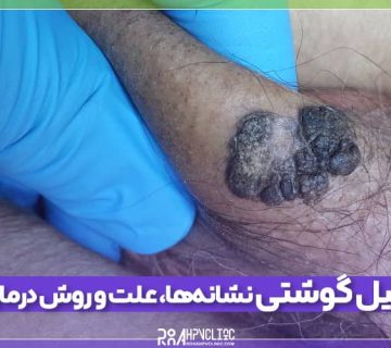 زگیل گوشتی