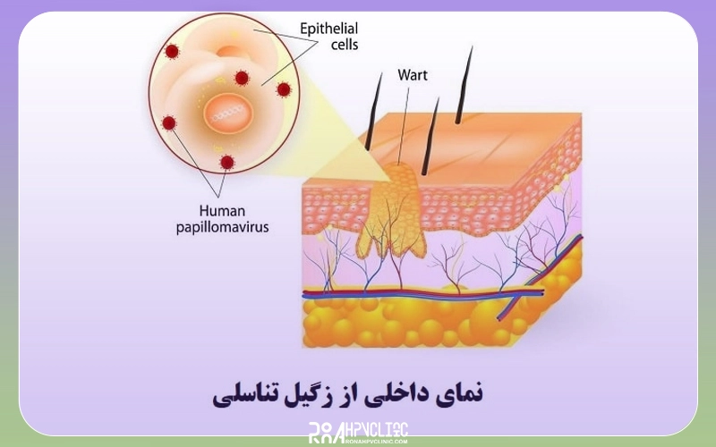 طول عمر ویروس زگیل تناسلی در داخل بدن