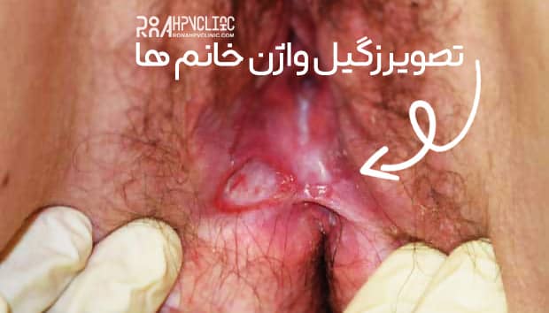 تصویر زگیل واژن خانم ها